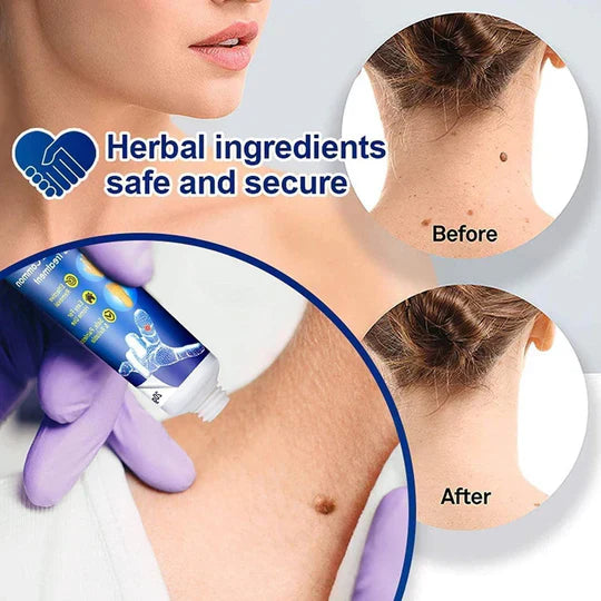Wart Remover Instant Cream Pack of 2